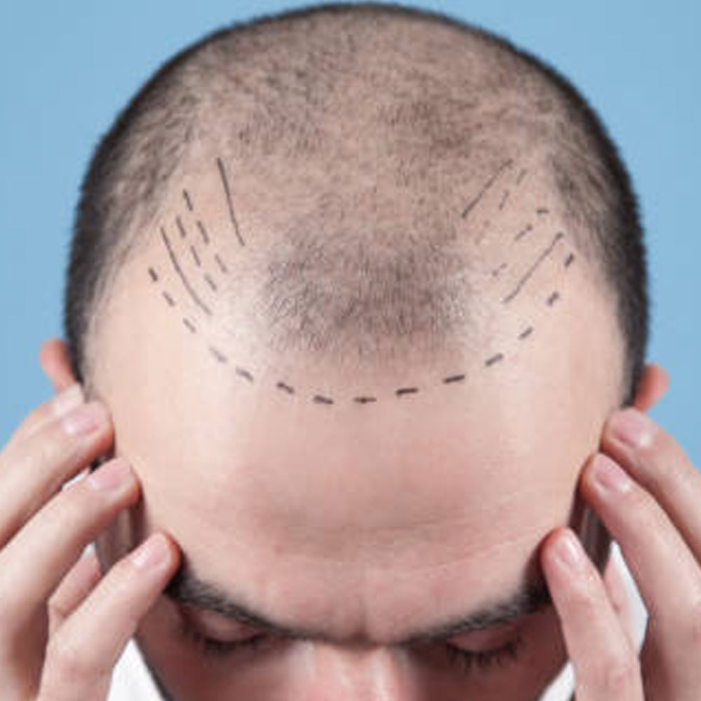 Hair Loss Treatment Treatment Pune | Hair Fall Solution Pune